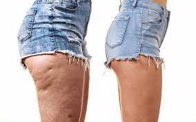 COMMENT REDUIRE SA CELLULITE ?